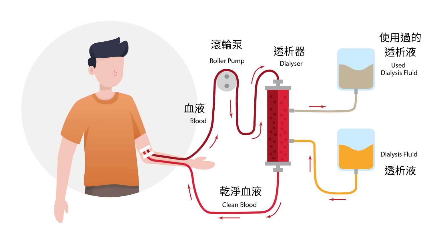 血液透析(Hemodialysis)